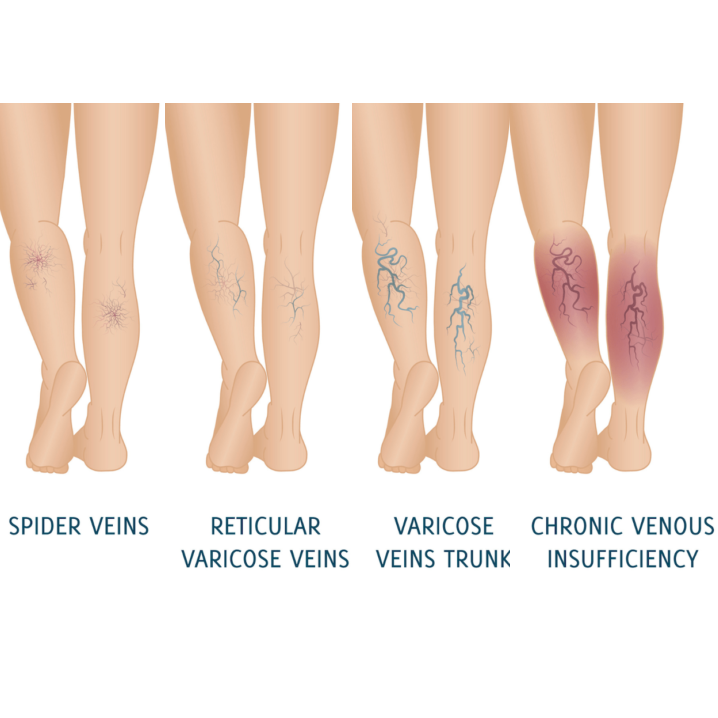 Suy giãn tĩnh mạch chân mãn tính