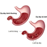 Viêm loét dạ dày tá tràng trào ngược